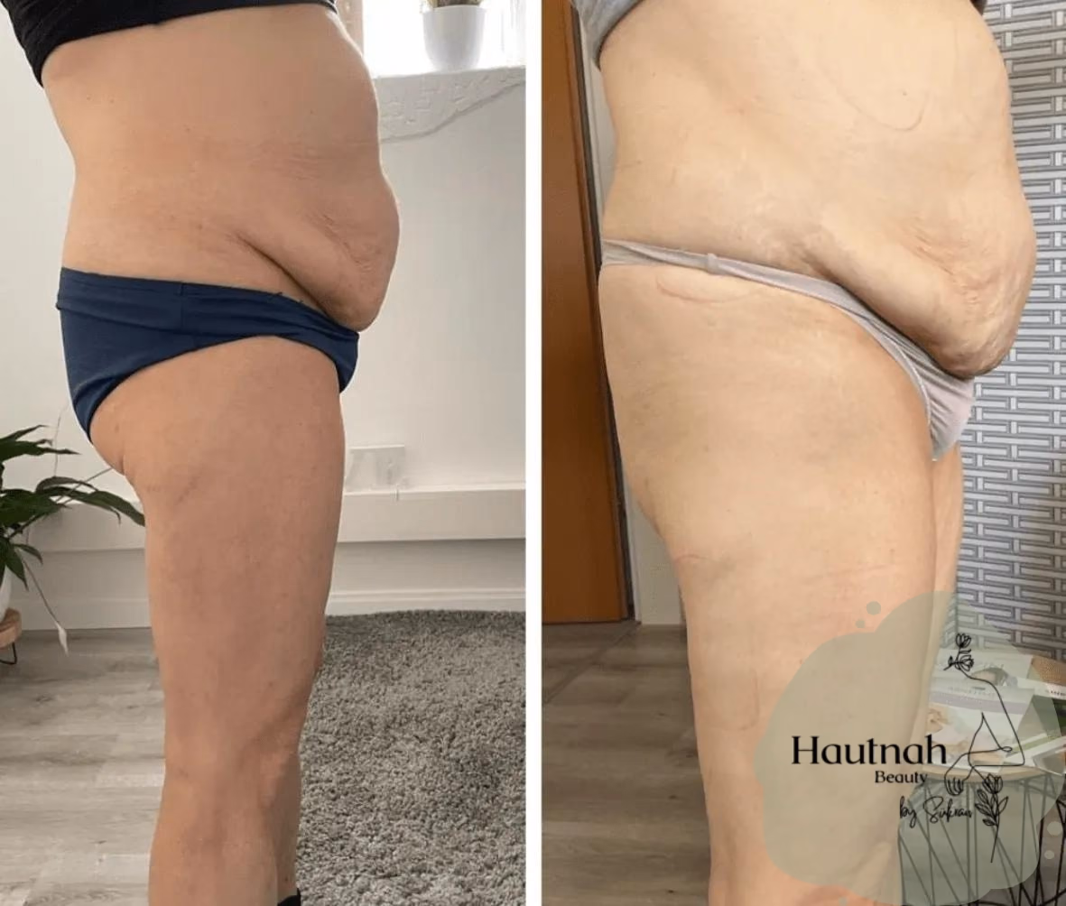 Abnehmen im Liegen: Vorher-Nachher-Vergleich, Seitenansicht Bauch und Oberschenkel