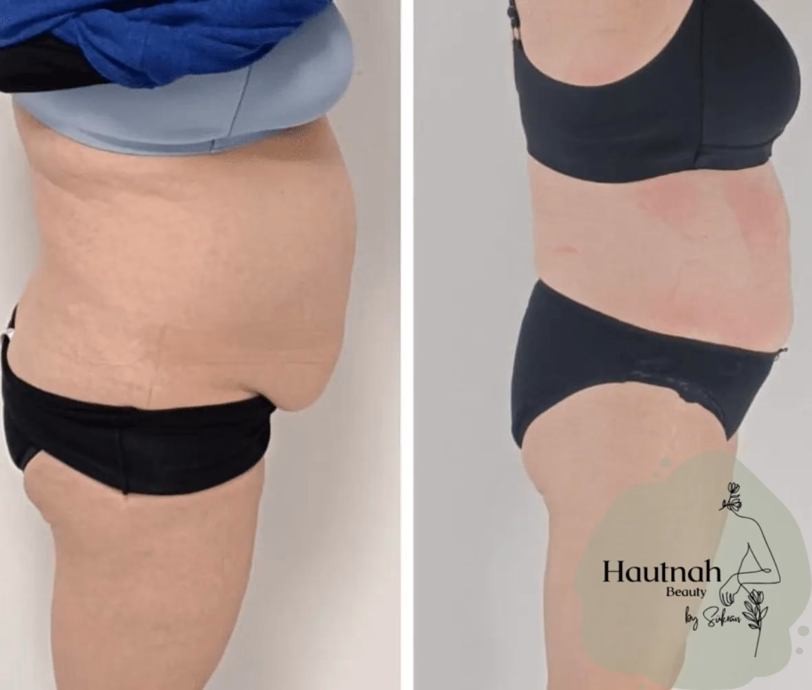 Abnehmen im Liegen: Vorher-Nachher-Vergleich, Seitenansicht Bauch und Hüfte