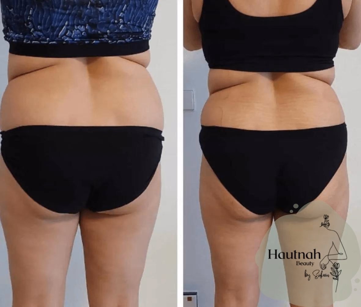 Abnehmen im Liegen: Vorher-Nachher-Vergleich, Seitenansicht Bauch