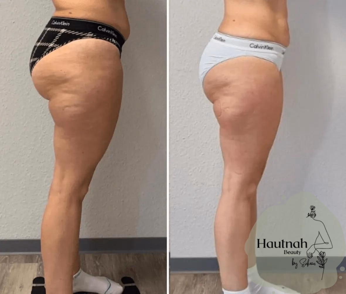 Abnehmen im Liegen: Vorher-Nachher-Vergleich, Seitenansicht Bauch und Taille