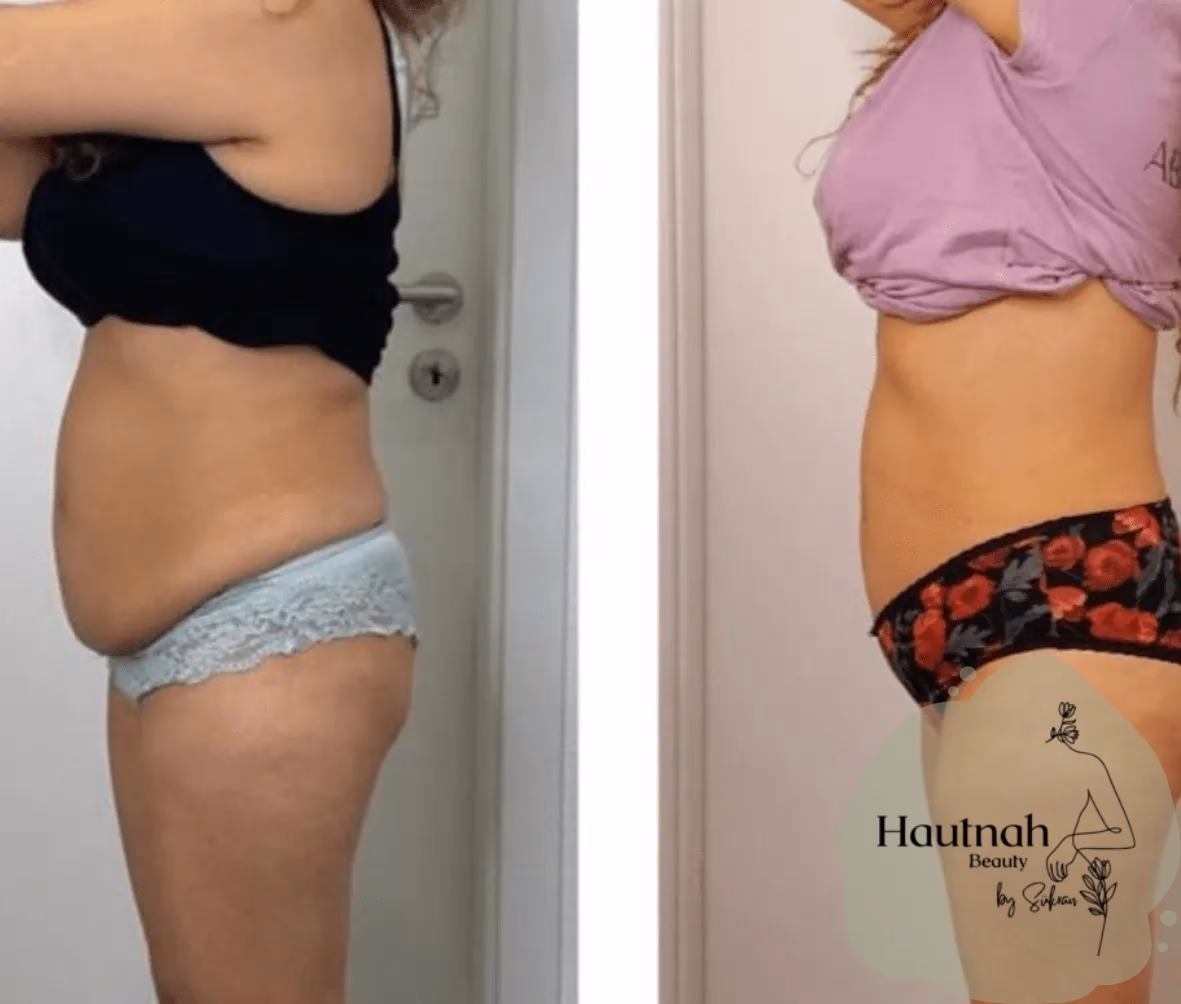 Abnehmen im Liegen: Vorher-Nachher-Vergleich, Seitenansicht Bauch und Oberschenkel