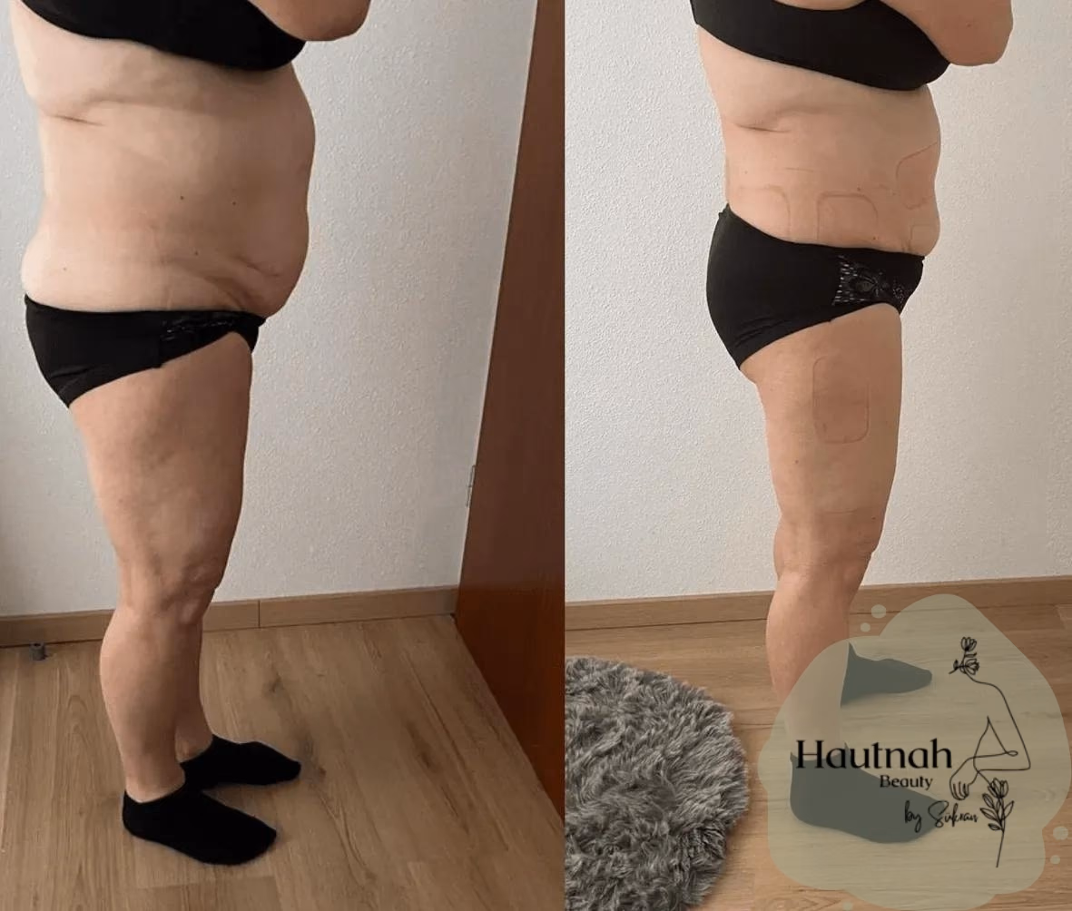 Abnehmen im Liegen: Vorher-Nachher-Vergleich, Seitenansicht Bauch und Hüfte