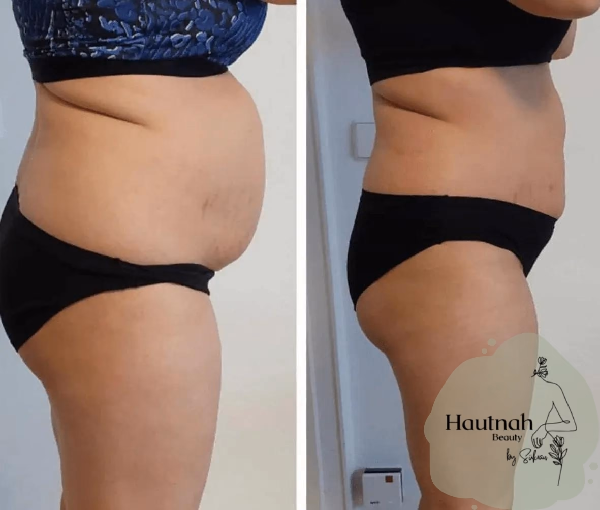 Abnehmen im Liegen: Vorher-Nachher-Vergleich, Seitenansicht Bauch